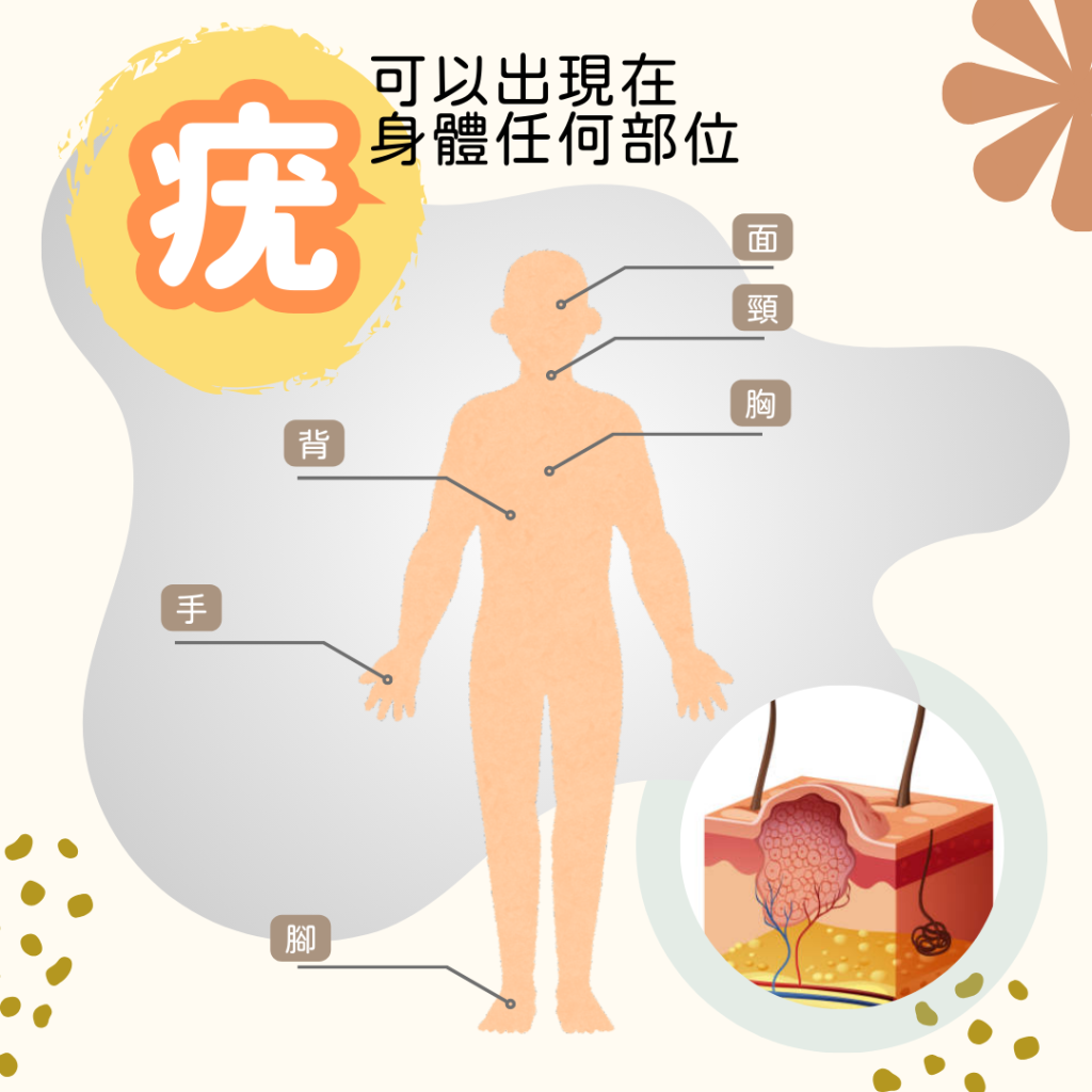 疣可以在身體任何部位出現, 例如面、頸、胸、背脊、手或腳.