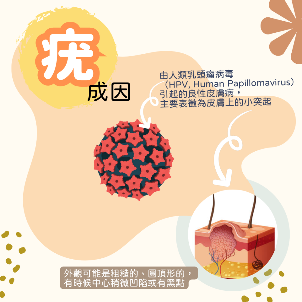 疣由HPV人類乳頭瘤病毒引起,是良性的皮膚病,表徵為皮膚上的小突起.
