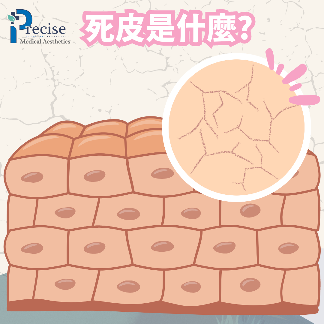 死皮原因 死皮怎樣處理