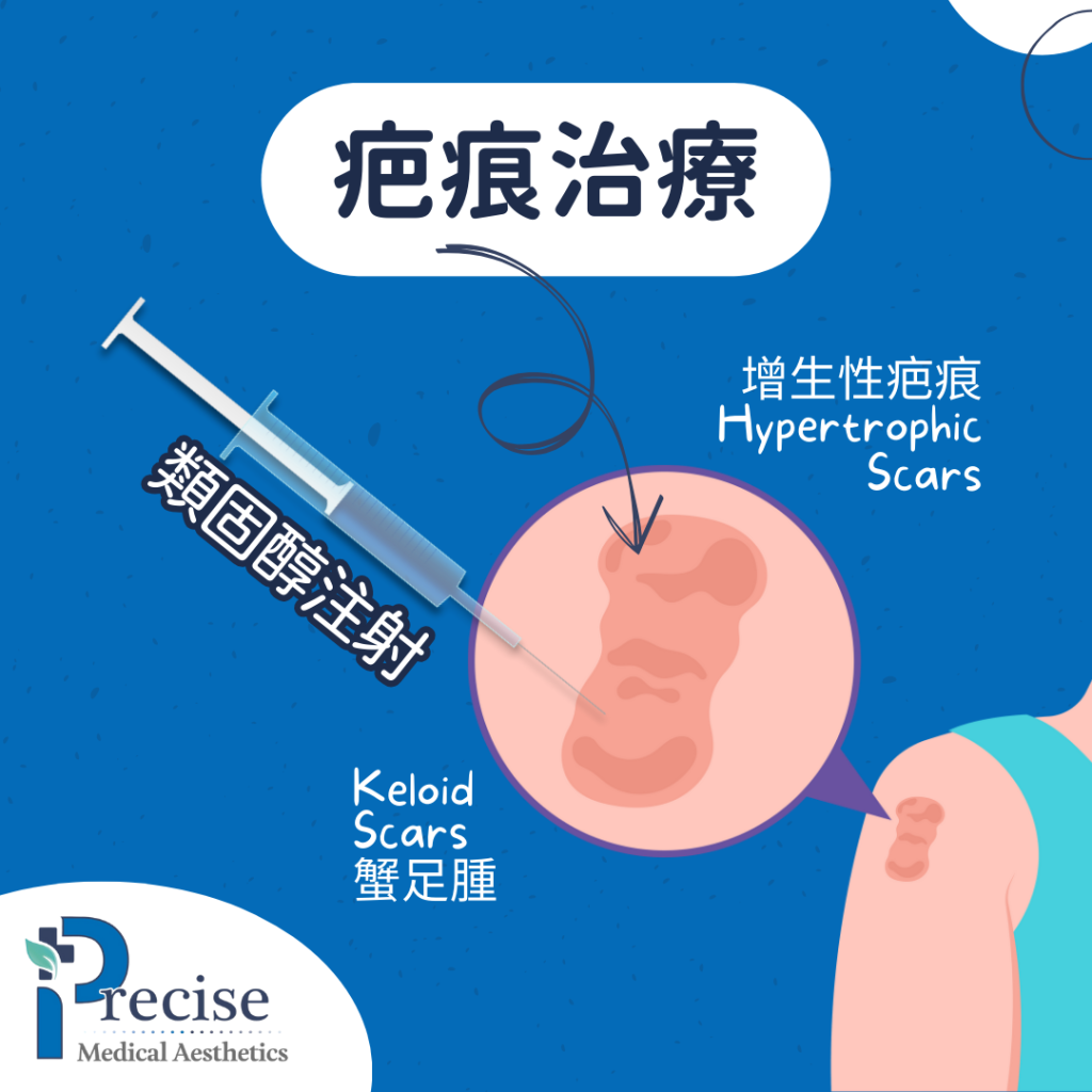 什麼是疤痕 蟹足腫 打針 為什麼會形成疤痕 疤痕增生 疤痕治療方案 醫學美容 尖沙咀 美麗華診所 症狀及消除蟹足腫的方法 疤痕增生的預防及治療 除疤針價錢