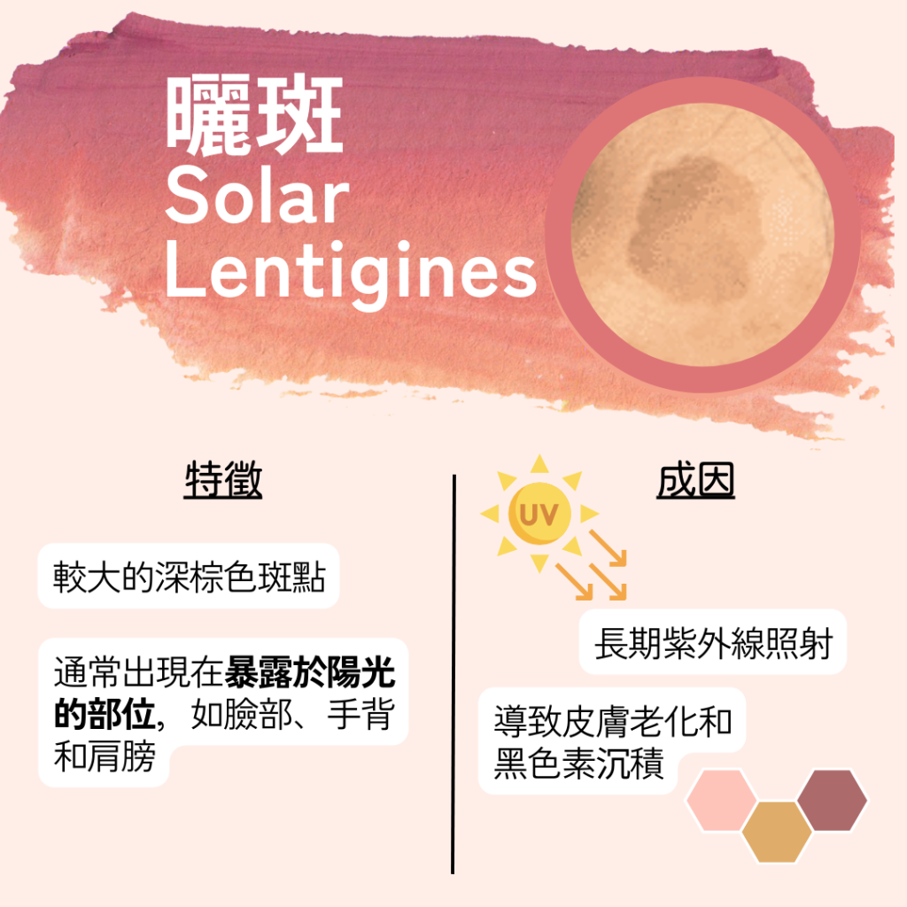 曬斑:與雀斑有何不同?醫生推薦4大快速淡斑方法!曬斑會消失嗎?認識斑點類型,全面解析淡斑
