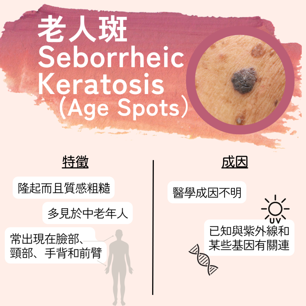 老人斑是甚麼?老人斑的預防及治療方法在此!老人斑不是年紀大才出現!老人斑原來是皮膚病