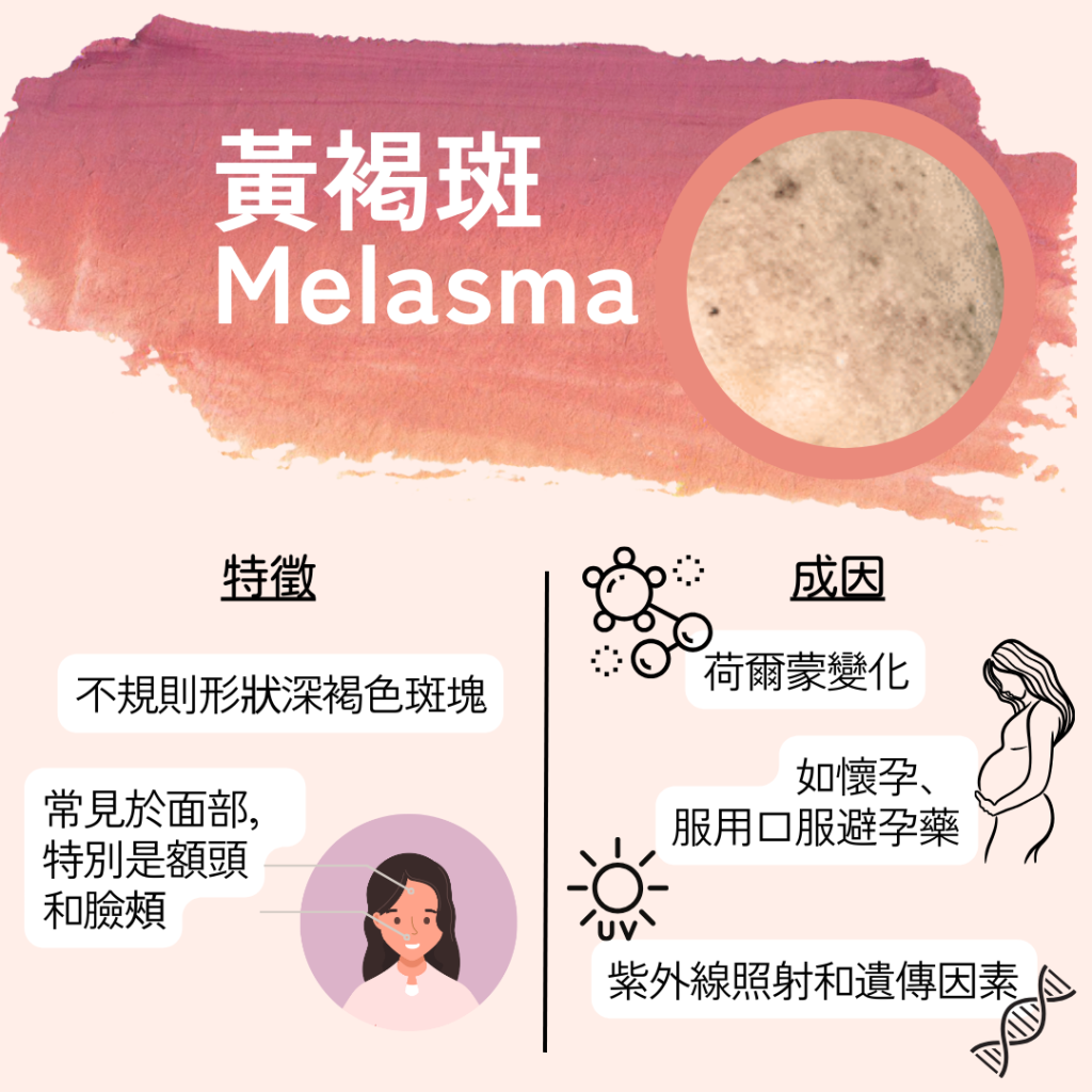 黃褐斑又稱荷爾蒙斑或肝斑. 如何有效祛除黃褐斑?最新治療方案總覽!其難以治癒和容易復發而聞名,被譽為色斑中較難處理的一種