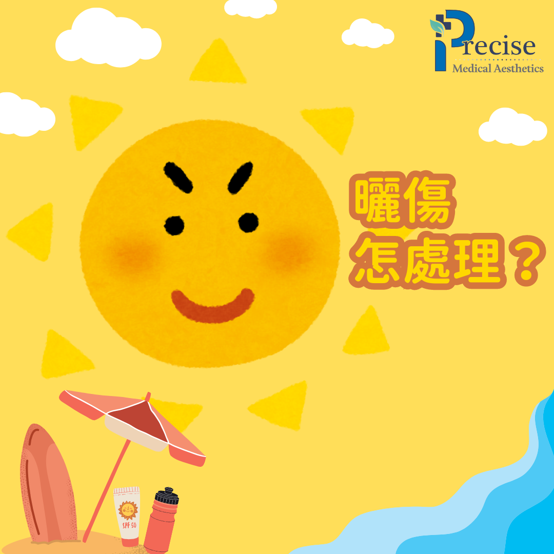 曬傷點好 曬傷點算 曬傷處理