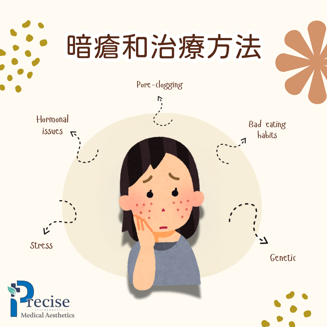 暗瘡原因 暗瘡治療 預防暗瘡 暗瘡療程 暗瘡美容