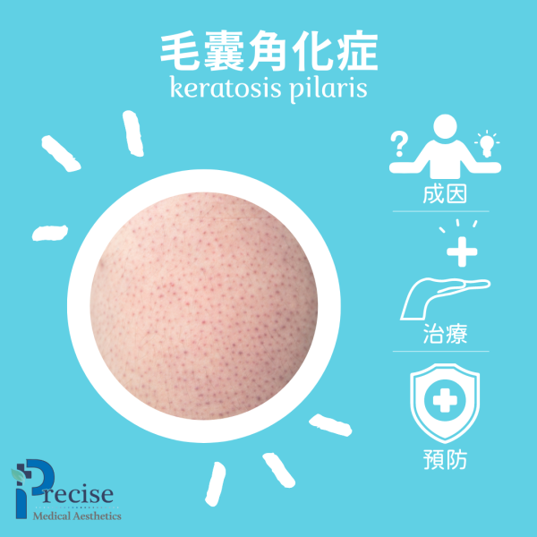 毛囊角化症怎麼治療 毛囊角化症可以擠嗎