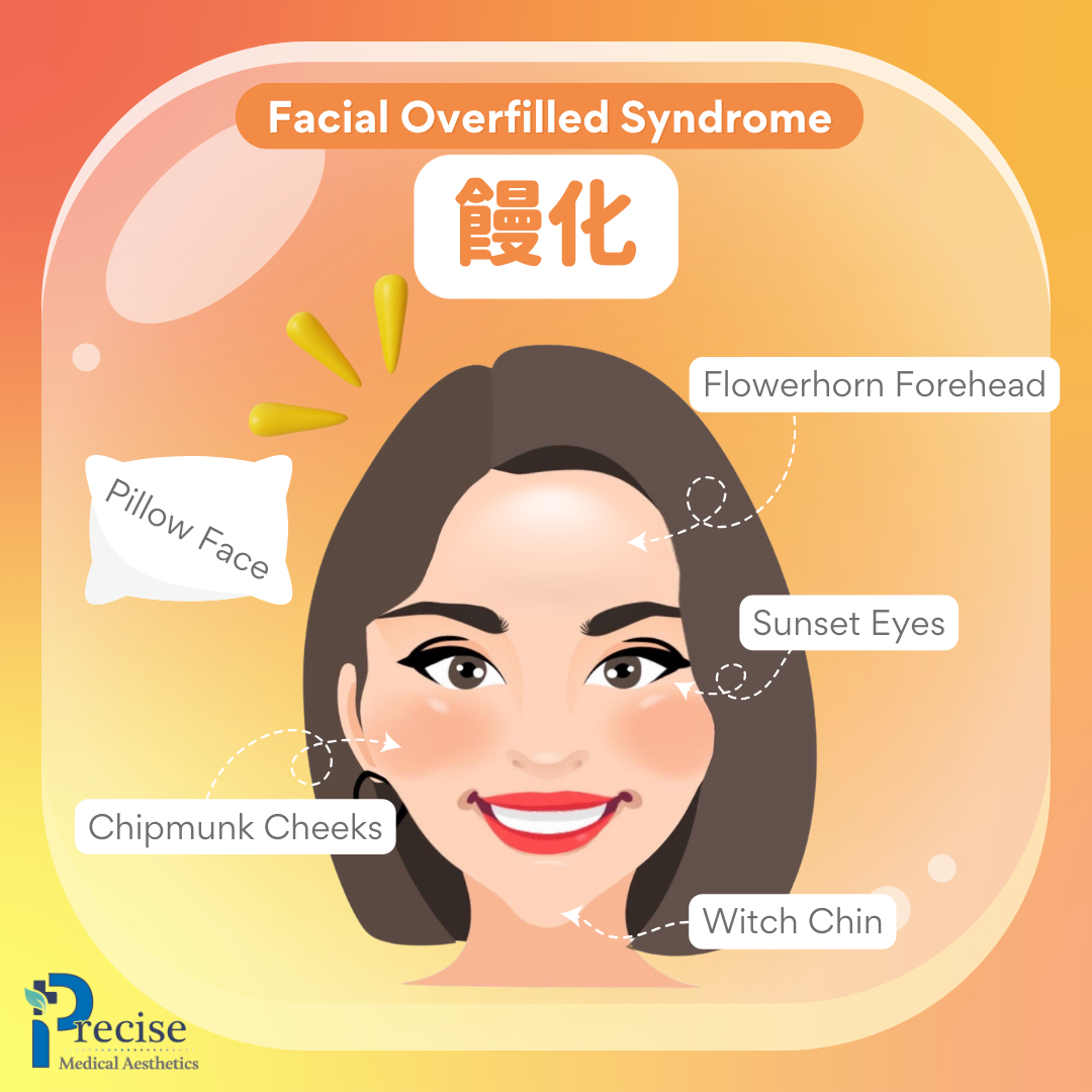饅化 Facial Overfilled Syndrome 饅化臉 填充劑 美風險 饅化臉原因