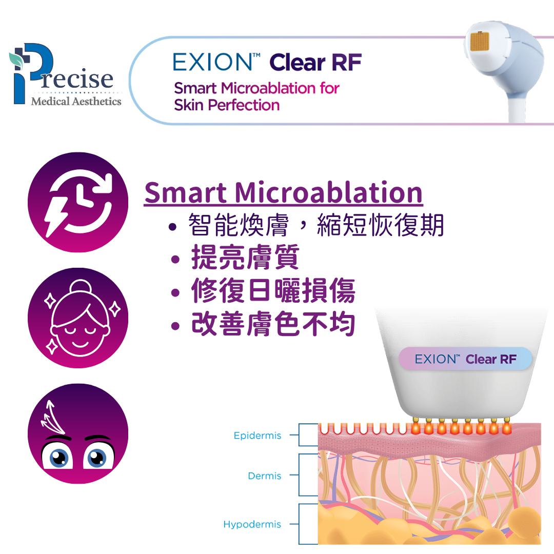Exion clear rf 醫生療程 智能煥膚 改善眼袋 撫平眼紋 收緊下垂眼簾 改善眼皮浮腫