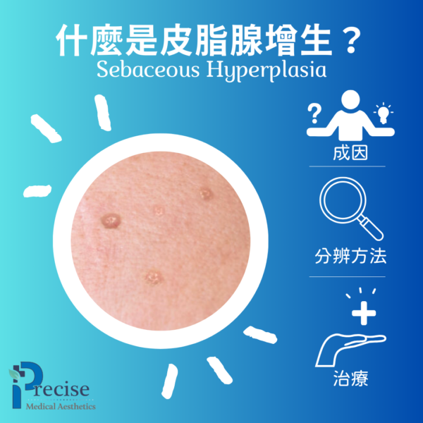 Sebaceous Hyperplasia 皮脂腺增生 臉上小顆粒 額頭凸起 眼周小粒粒